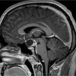 Craniopharyngioma Craniopharyngioma and other pituitary/sella lesions