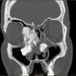 osteoma Extensive osteoma and other fibro-osseous lesions