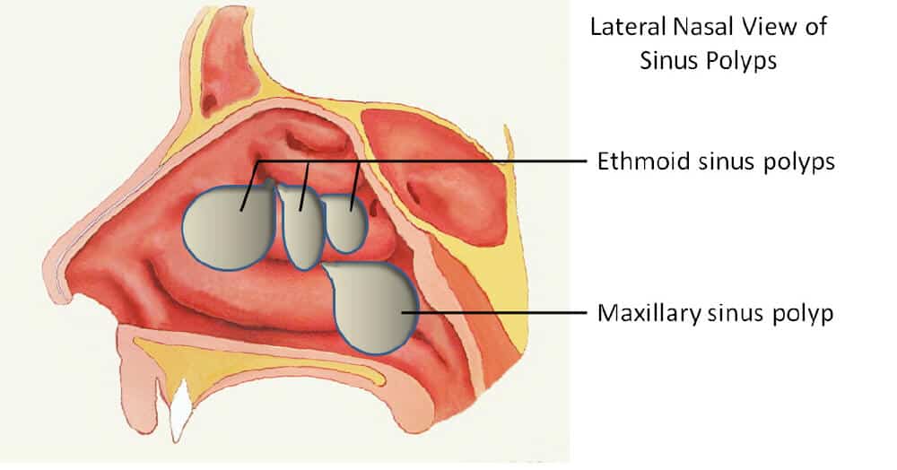 polyps in the nose