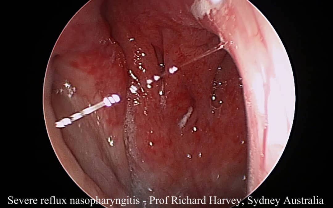 Post nasal drip a chemical or viral pharyngitis