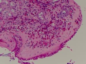 nasal-polyps-richard-harvey-sydney-tissue-eosiniophillia