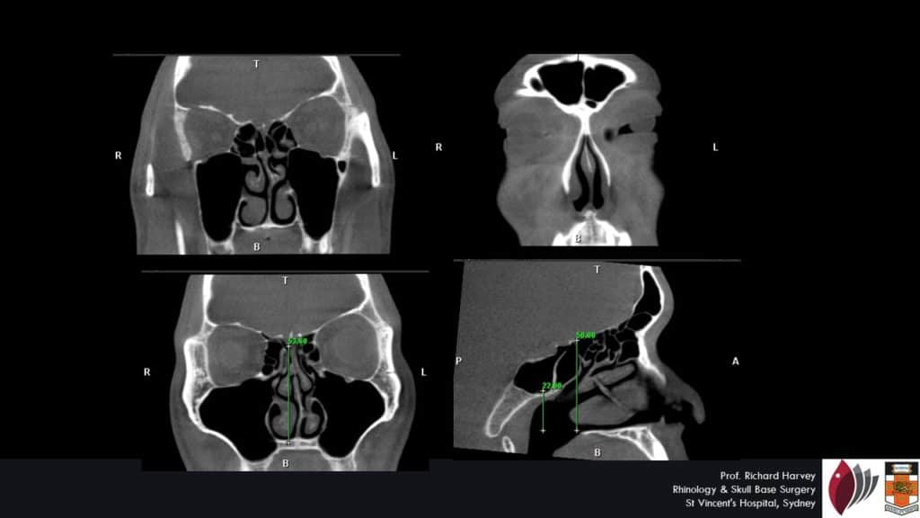 The price of Nose and Sinus Surgery Sinus surgery cost