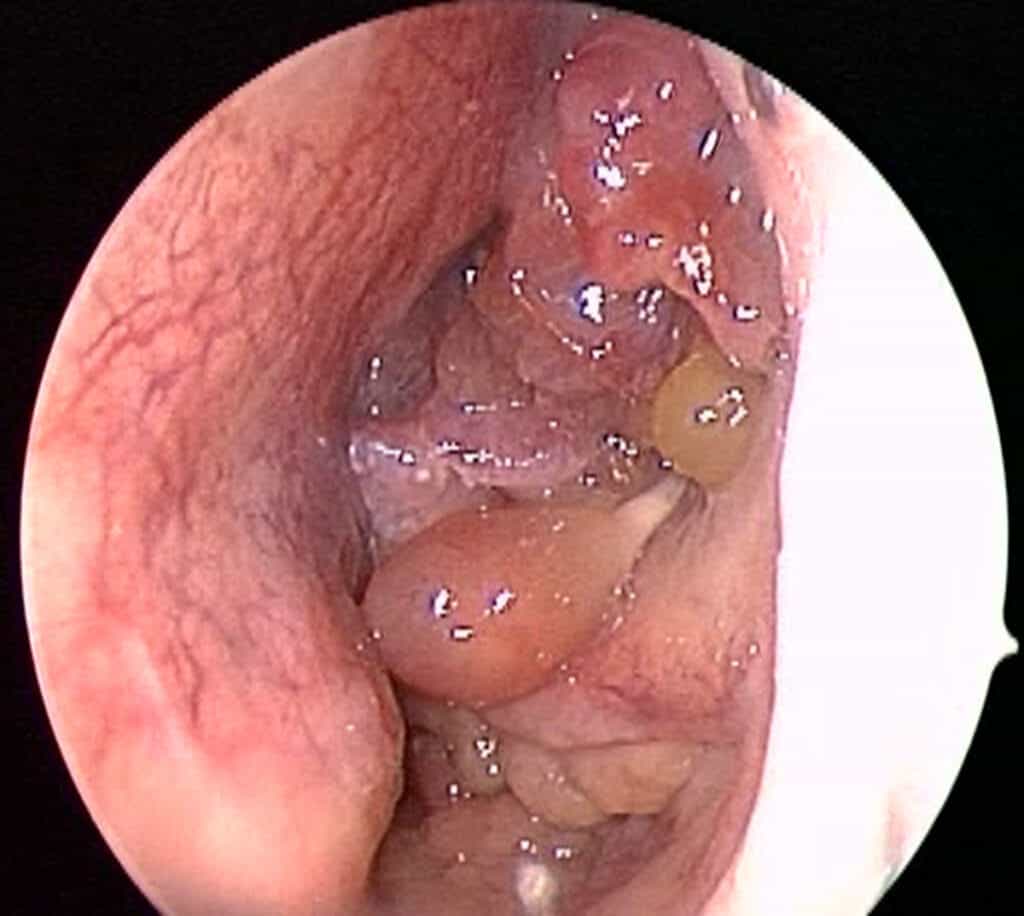 chronic sinus symptoms polyps polyposis