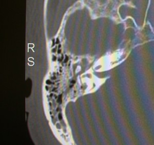 Coronal CT scan of the temporal bones. The mastoid air cells are filled with blood. A fracture line is seen travelling through the otic capsule which has resulted in a complete vestibular and hearing loss on this side.