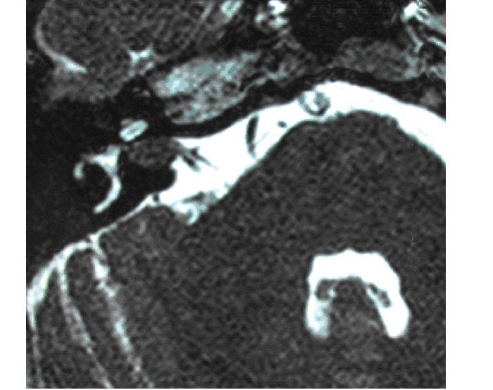 T2 weighted acoustic neuroma (vestibular schwannoma) confined to the internal auditory canal.