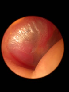 A microscopic picture of a right ear. A reddish mass can be seen behind the tympanic membrane (ear drum), in the postero-inferior quadrant. This tumour can be contained only within the middle ear, or can represent the 'tip of the iceberg', having extended superiorly from the jugular foramen.