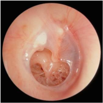 A larger perforation of the ear drum. Currently there is no infection, but is associated with a significant conductive hearing loss.