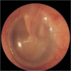 A picture of a normal tympanic membrane.