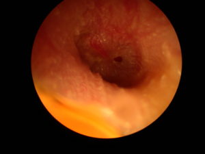 Small perforation in the tympanic membrane. There is evidence of co-existing infection. This perforation occured following a fall from a surfboard onto the water. Similar injuries can occur after a blow the the external ear due to a pressure wave created down the ear canal. If the infection can be cleared, most of these perforations heal spontaneously.