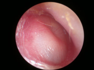 A microscopic view of the right ear. This is the classic appearance of glue ear, with a mucopurulent effusion present behind the drum.