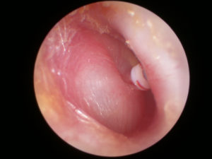 A photo taken immediately following ventilation (grommet) insertion. It is placed into the antero-inferior aspect of the ear drum.