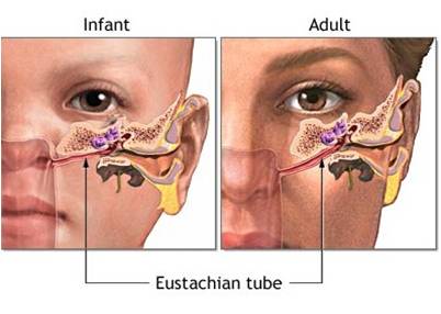 A picture showing the anatomical differences between the infant and adult eustachian tubes
