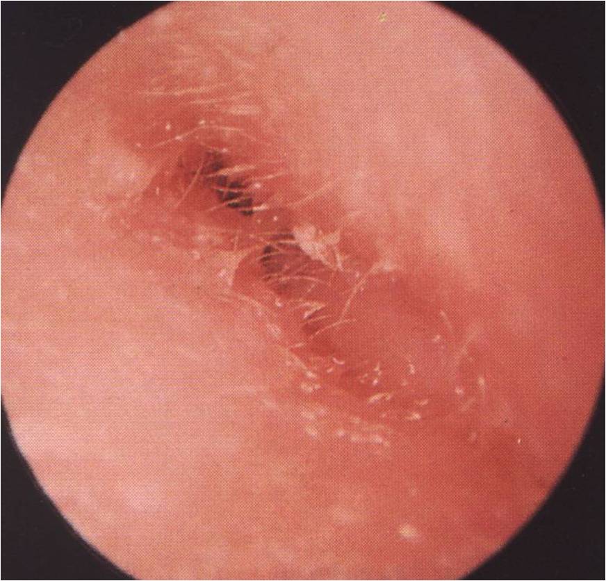 treatment e skin coli infection) Otitis or ear (outer Dr  Externa ear swimmers