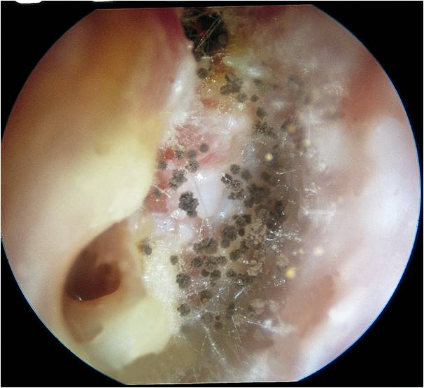 Glue Ear, Middle Ear Infections and Grommets