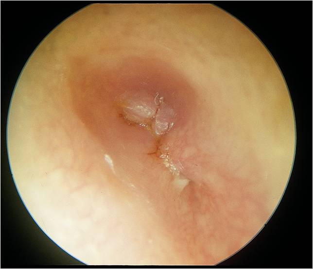 Glue Ear, Middle Ear Infections and Grommets