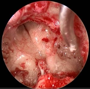 Endoscopic view of left ear following removal of extensive middle ear cholesteatoma