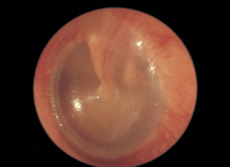 ruptured tympanic membrane