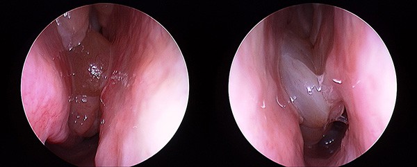 Chronic Sinus Problems - Sydney ENT Clinic