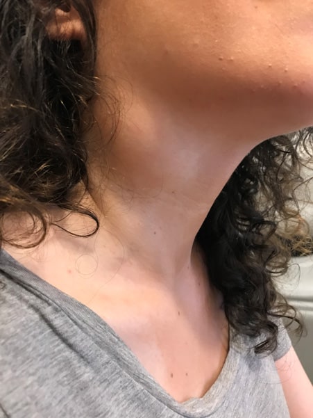 bump on neck