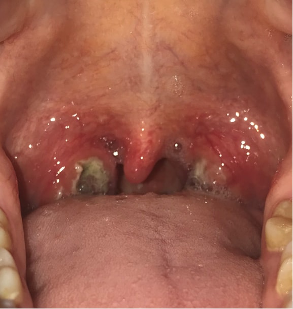 severe tonsil infection